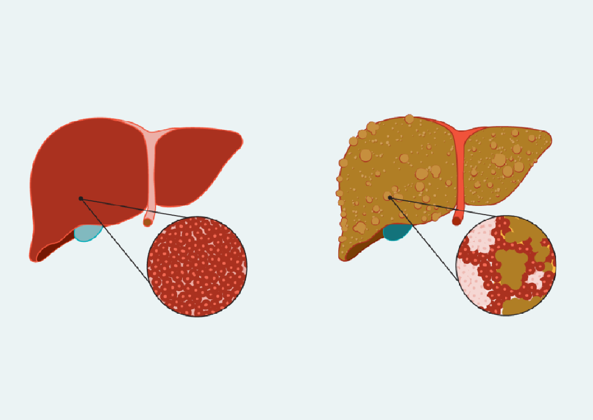 cirrhosis